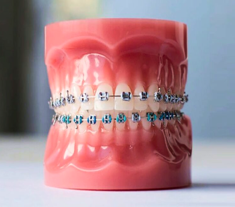 Metal Braces