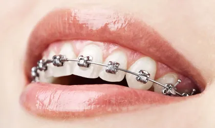 4 Key Ways to Keep Your Teeth Healthy After Orthodontic Visits-photo