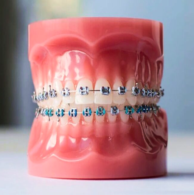 Metal Braces-photo
